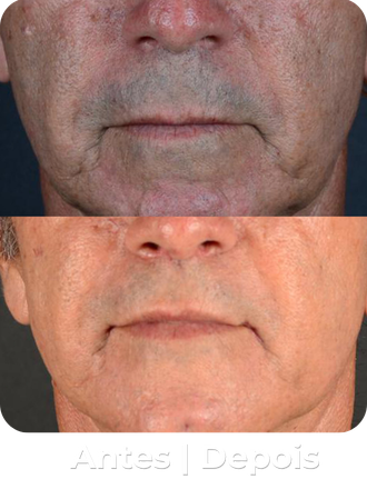 Antes e depois 1