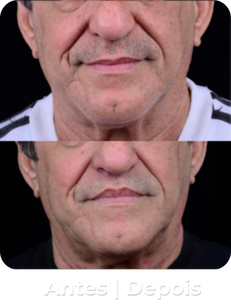 Antes e depois 2