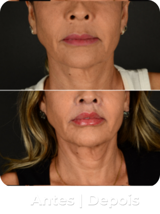Antes e depois 4